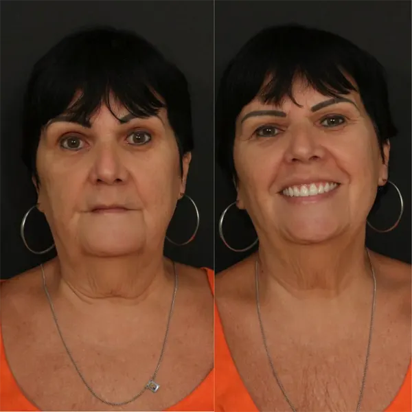 Beige Minimalist Skincare Before and After Instagram Post.png 1