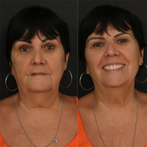 Beige Minimalist Skincare Before and After Instagram Post.png 2