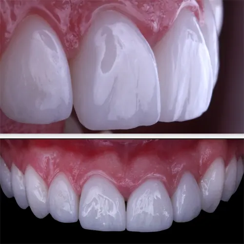 treatment11